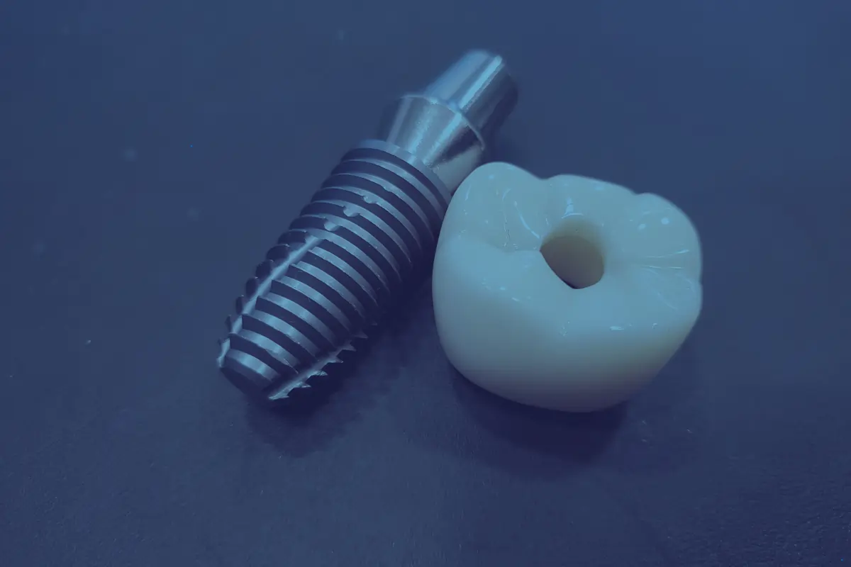 Couronne dentaire blanche et implant métallique posés côte à côte sur un fond bleu foncé.