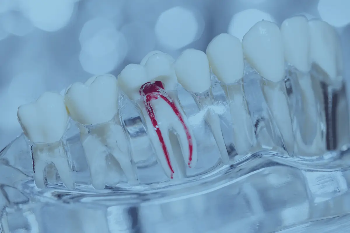 Modèle dentaire transparent avec l’intérieur d’une molaire représenté en rouge.
