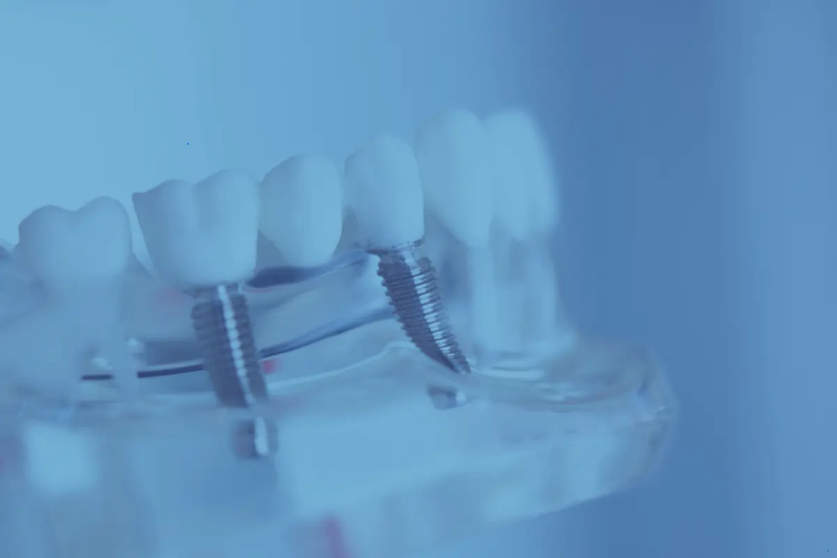 Modèle de mâchoire transparent avec des dents blanches et deux implants métalliques visibles.